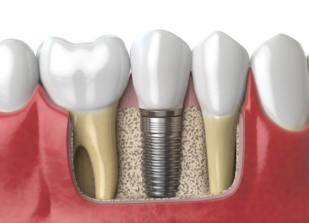 Implantologia dentale DentalBiotech Pescara
